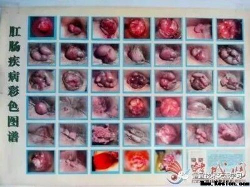 【5月10日】肛肠病穴位针挑疗法班~大胡子痔疮王雷虎成