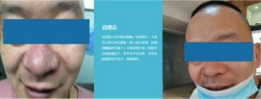 适温消融技术的临床应用