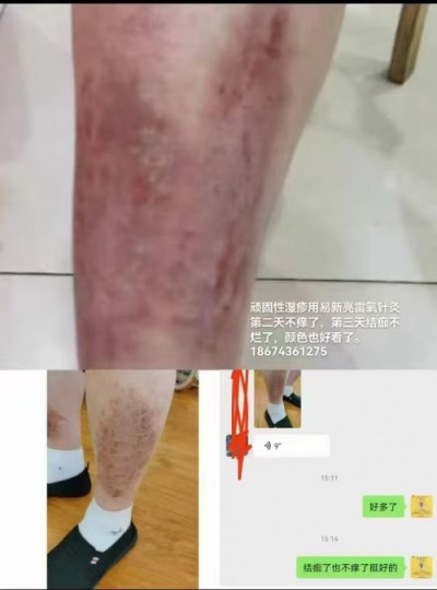 湘水易医易新亮靶向针灸断根疗法：道医智慧与现代科技的融合探索