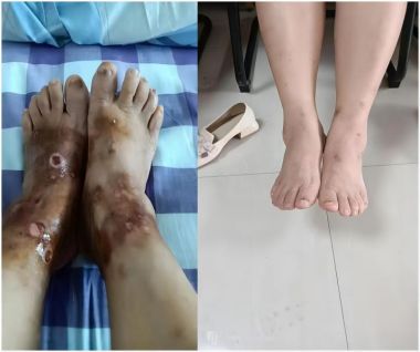 中医传国脉 岐伯济天下 治瘫奇人---鄢正甫